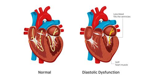 left ventricular diastolic dysfunction symptoms